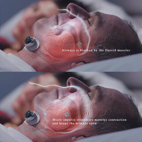 Smart Anti Snoring Device Magnetic Patch Snore Stopper Electric Throat Muscle Stimulator No Snoring Anti Ronquidos Travel Home